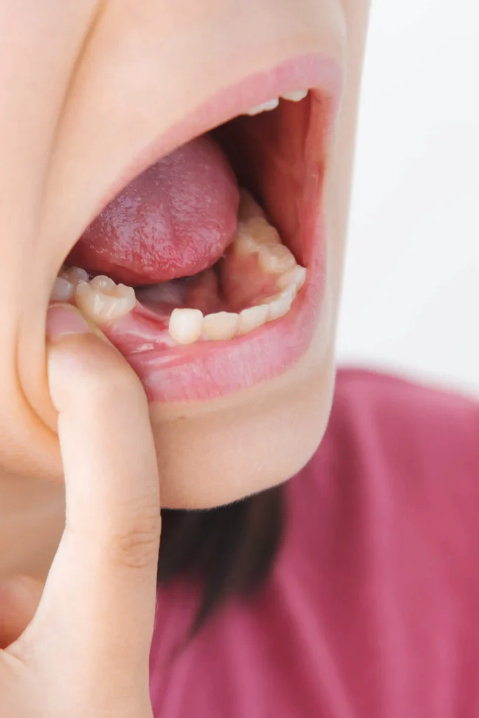 Child points to a missing lower baby tooth inside an open mouth.