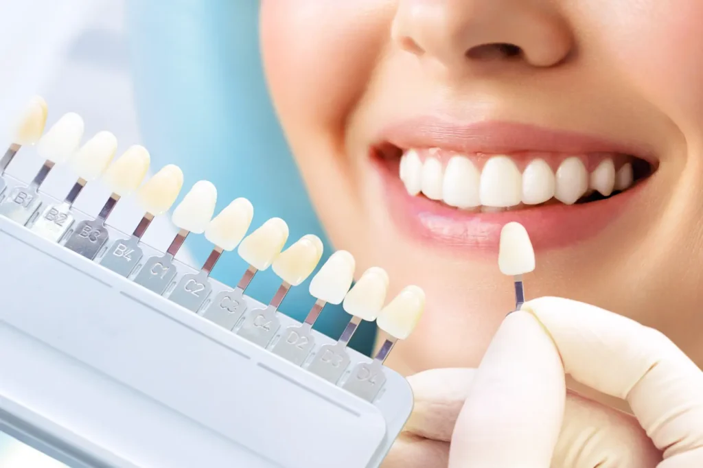Dental professional comparing a tooth shade guide to a smiling person's front teeth.