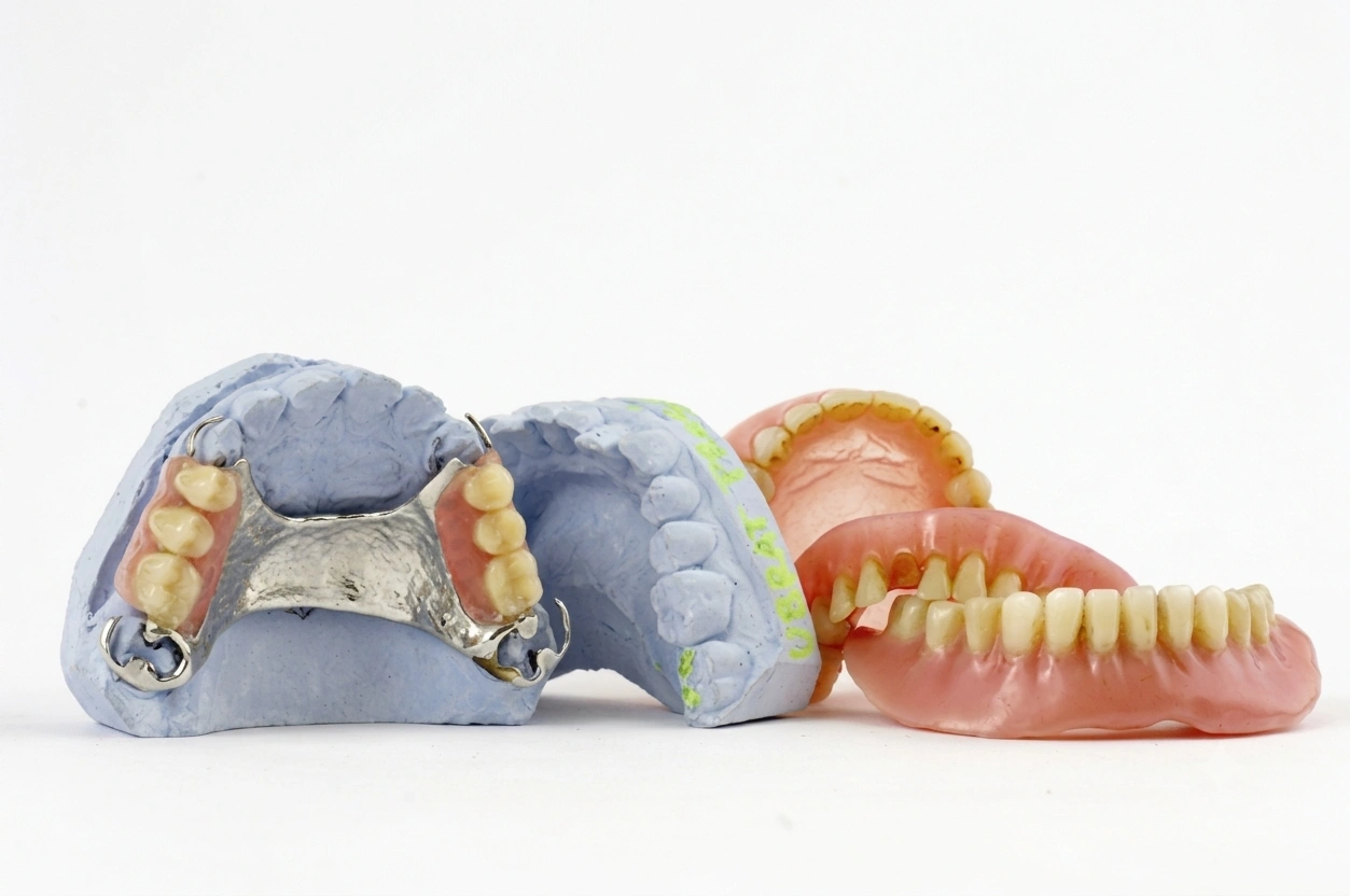 A partial denture used to replace missing teeth