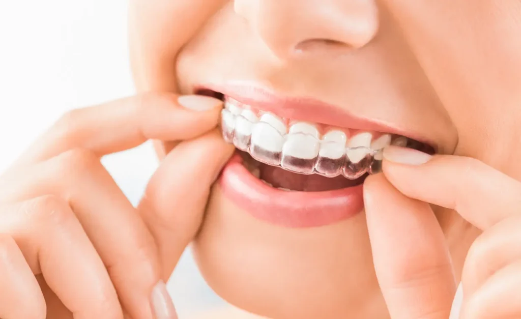 Close-up of hands placing a clear aligner onto the upper teeth.