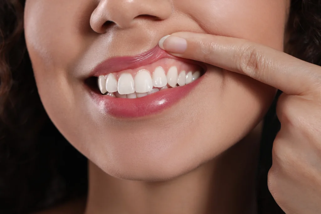 A balanced, natural-looking smile after cosmetic contouring