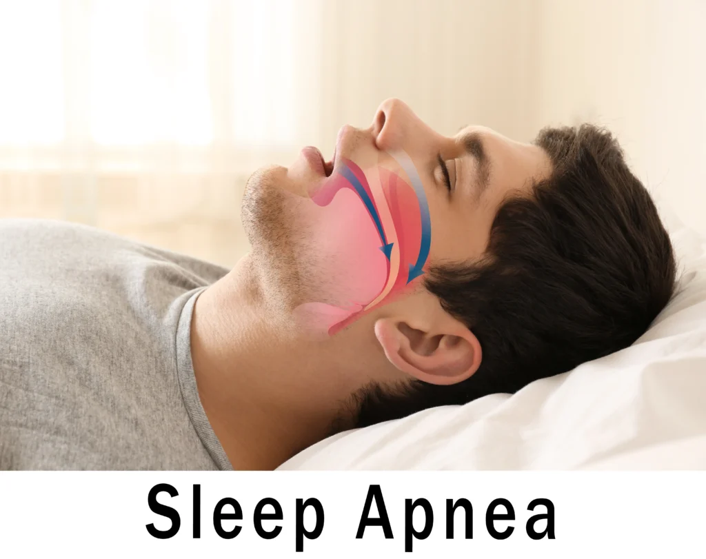Side profile of a sleeping man with an airway illustration and Sleep Apnea text overlay.